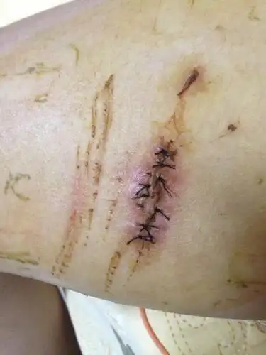 请有此经历的朋友看看,分别是两腿的伤口. 我老公大腿内侧被划了