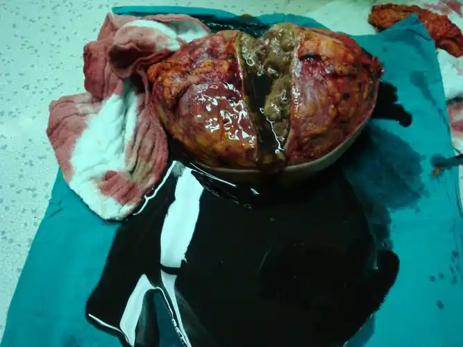 乳腺罕见肿瘤(附图片)结果及图片已更新! - 普外科讨论版 - 爱爱医医