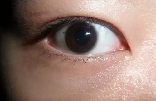 黑眼球里有黄色浑浊物体,请问这是什么问题?很担心会瞎掉或有后遗症!