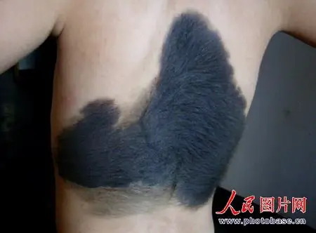 组图:男孩背上长胎记形似骆驼