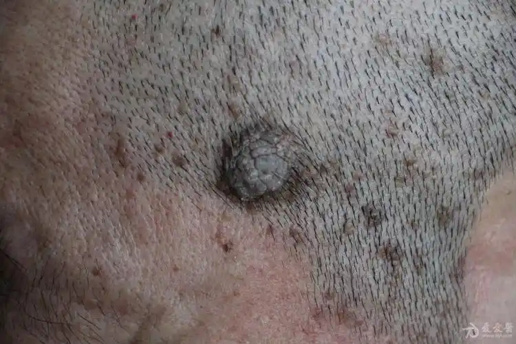 典型病例脂溢性角化病1