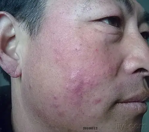 面部手背对称性丘疹20天