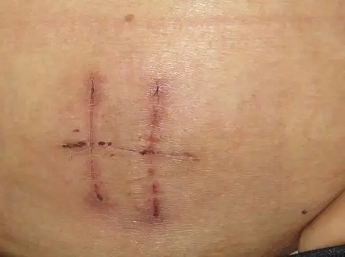 专业人士看一下,我这个结扎的刀痕,看下医生给我开了几刀?