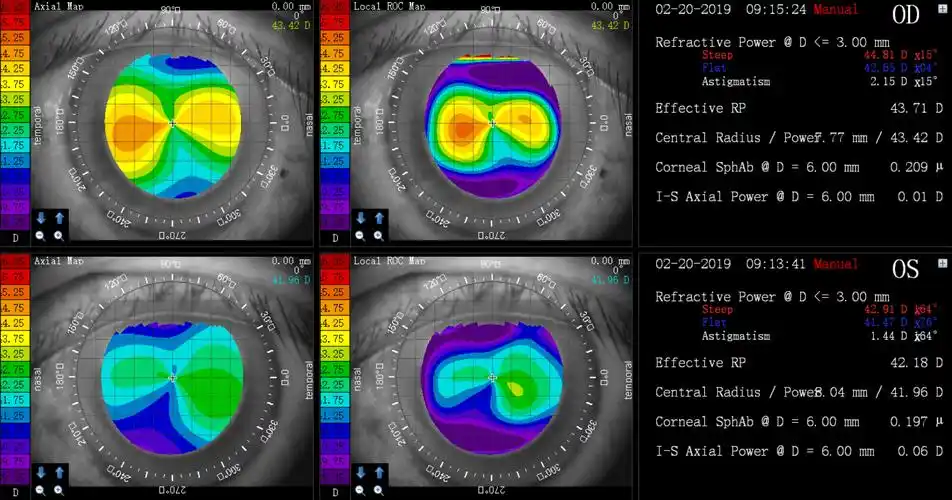 角膜地形图&像差原理解读(上) - 好大夫在线