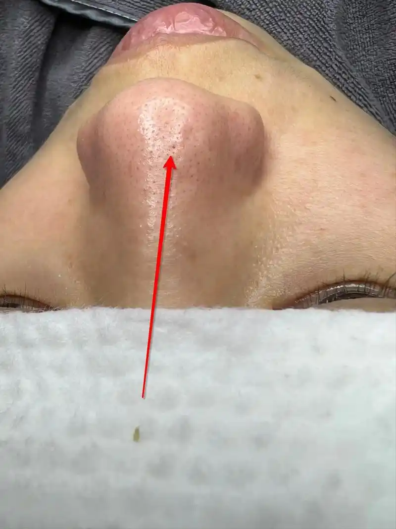 清黑头清痘痘清闭口.