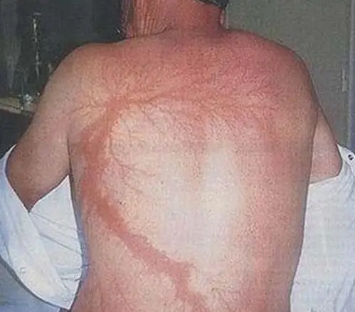 被雷劈中后大难不死,上天还送了他们一个礼物 ?