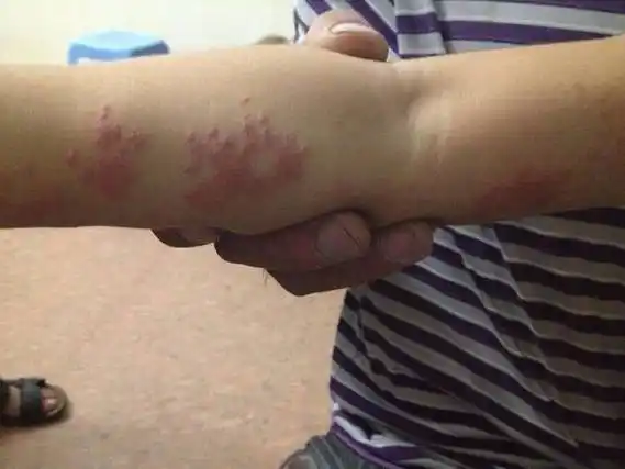 皮肤损害,通常可以分为单纯疱疹带状疱疹两种,具体如下1单纯疱疹单纯