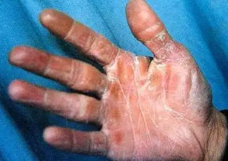 角化型手癣