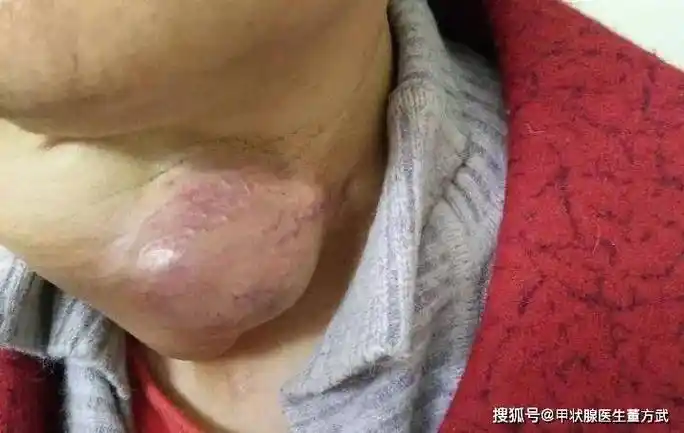 体检出现甲状腺结节,其中5%~15%是恶性!出现这些症状要注意了!