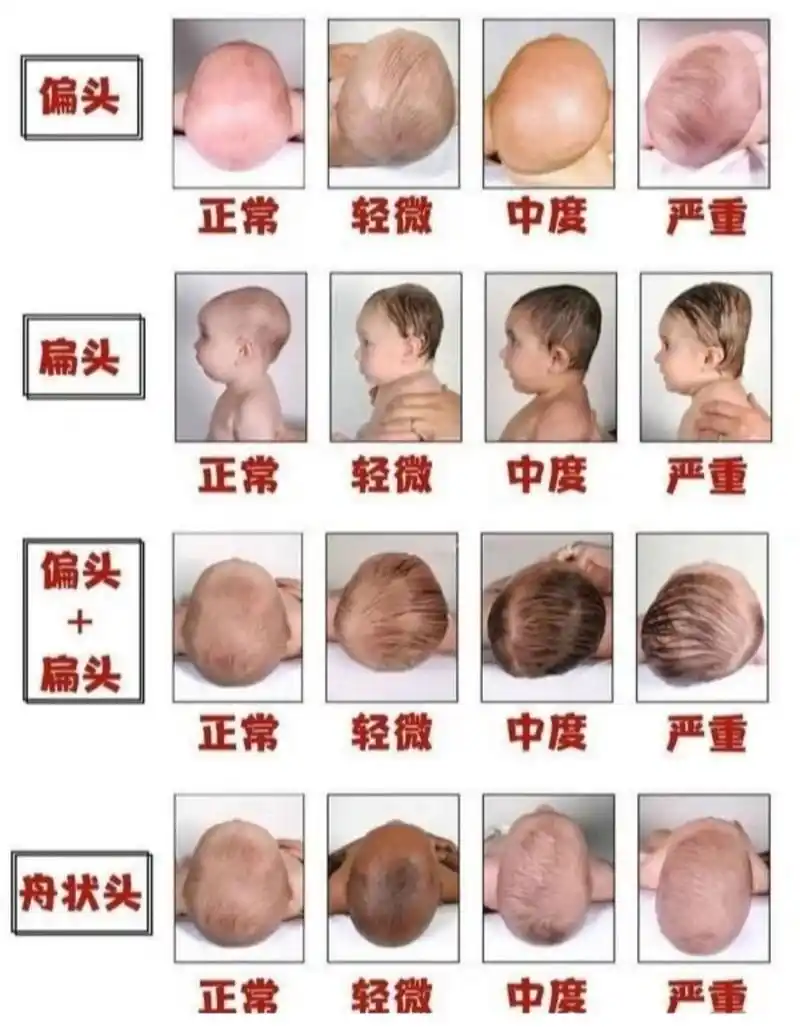 出生不久的宝宝头骨是比较软的,平时因为一 些不好的睡姿或是妈妈的