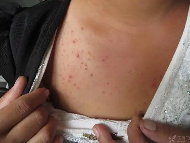 【请教】上胸出现的丘疹三个月,考虑什么