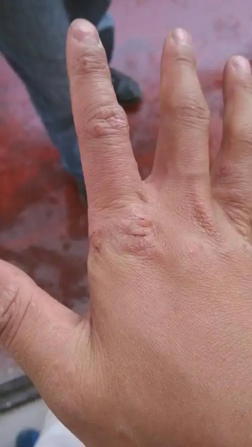 一直不见好.我该怎么办?手上长东西.医生说是湿疹.