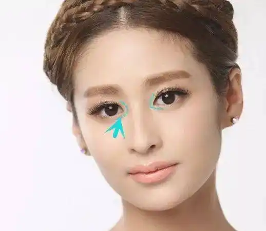 右眼有比较明显的蒙古褶,也就是内眦赘皮,所以眼头看起来比较圆钝