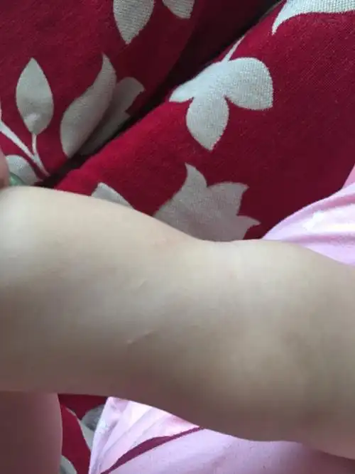 宝宝腿上出这样的痘痘是什么意思?