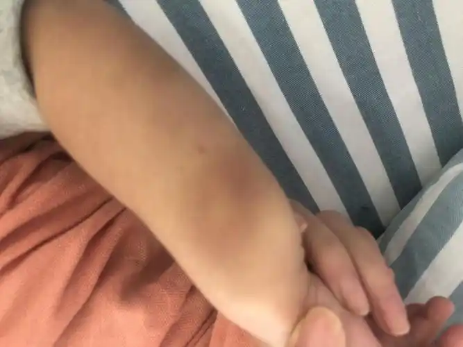 提醒家里的娃身上频现离奇淤青医生可能是吃出来的咋回事