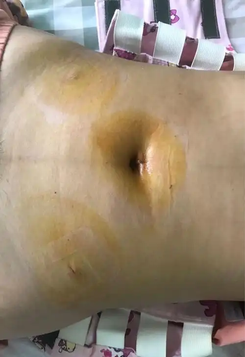 [试管婴儿]做手术啦宫腹腔镜.真的太遭罪了