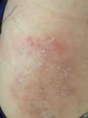 问:屁股上总是这样是怎么回事