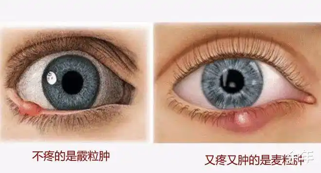 "看了不该看的东西"就会在眼睛上长出"挑针子",民间通俗叫法为"针眼"