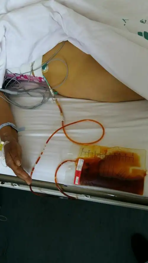 "扫黄"又有新进展了——纪我院首例胆道活检,支架置入术