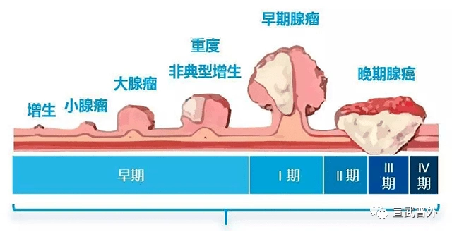 胃肠息肉知多少?