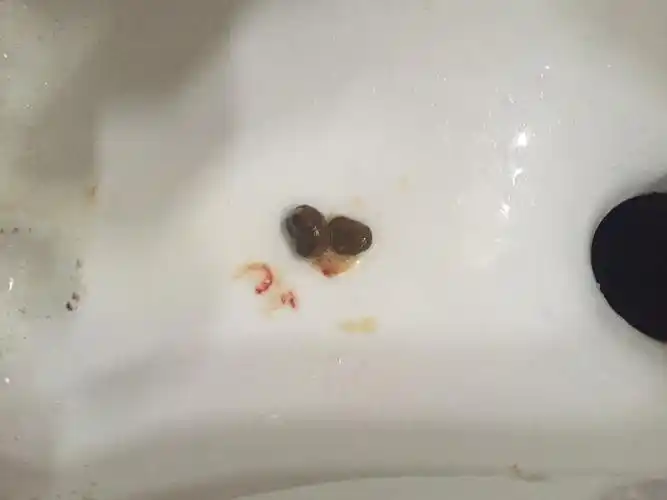 慢性胃炎的人大便带黄红粘液是什么原因引起