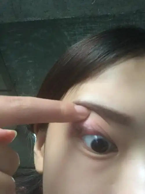 化妆品过敏上眼皮肿怎么办