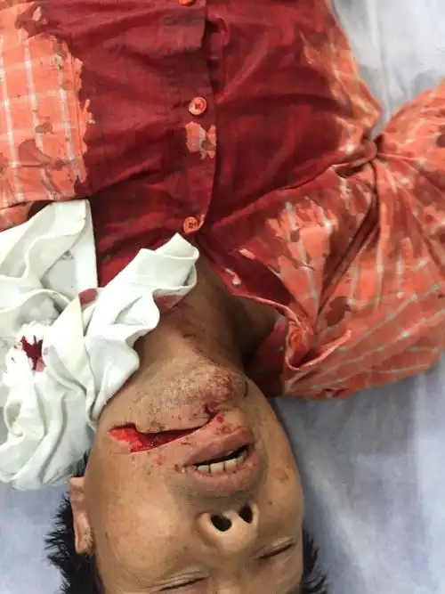 被别人刀砍的,算不算重伤?伤情鉴定是在出院以后才能鉴定吗?