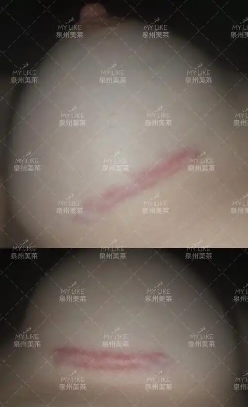 丰胸疤痕.jpg