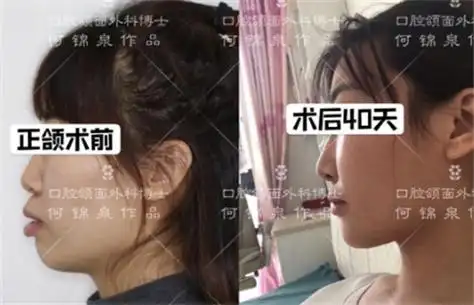 下面这则真人正颌前后对比照就能够让你看出正颌手术改善程度.