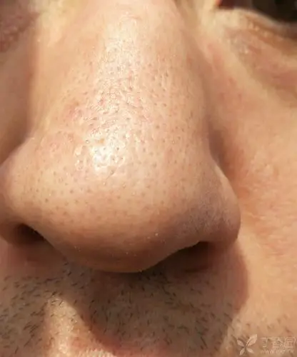 请教医生,毛孔粗大,白头旺盛