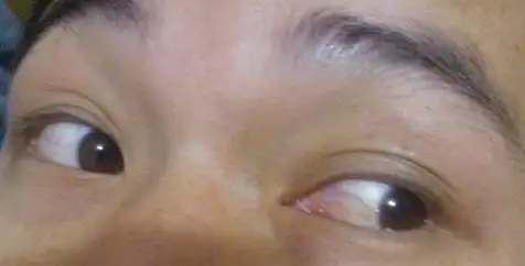 我的眼睛 是沙眼吗?