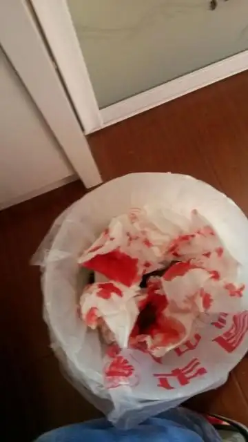 孕99天流鼻血好几次了