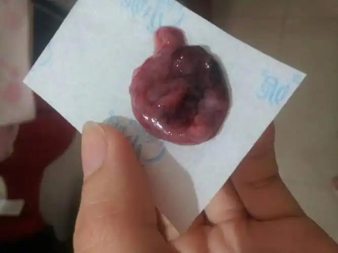 自然流产的,去小次就流血,好多,然后就流出这个了,没吃过任何药,请问