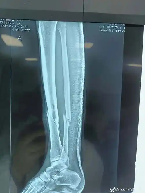 右胫腓骨下段开放性骨折治疗方案