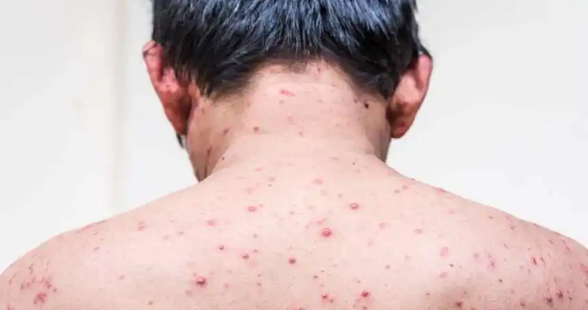 艾滋病初期的皮疹有什么特点