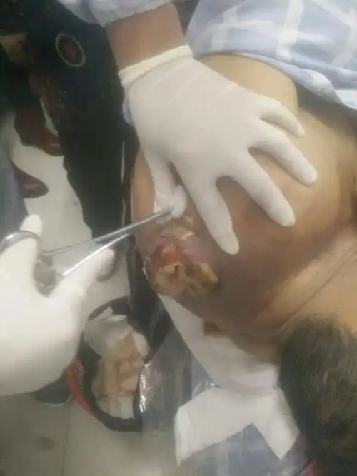 液氮冷冻治疗骨肉瘤伤口,治疗两次了,治疗前期在别的医院动了手术,做