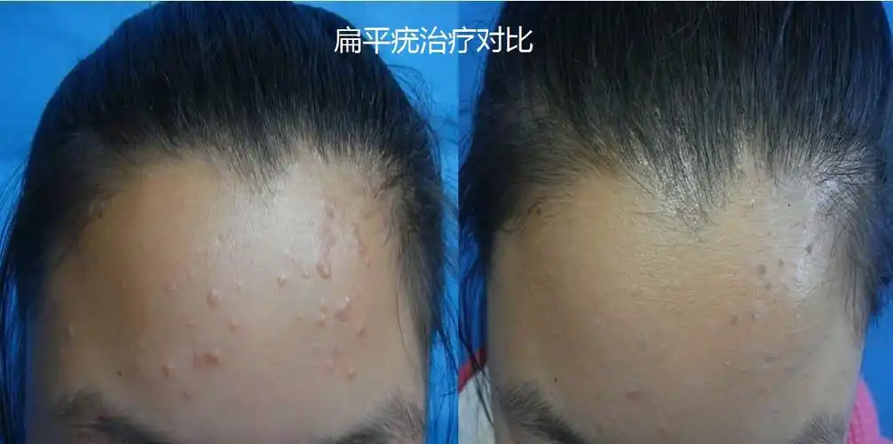 扁平疣治疗对比.jpg