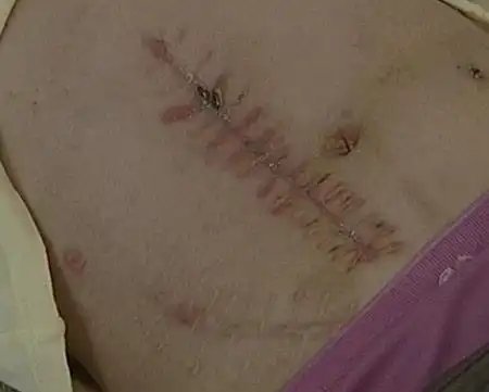 少女因阑尾炎开刀三次 小肠被误截2米多(图)