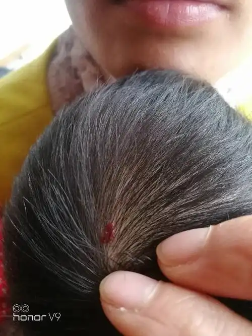 幼儿头上头皮有血块印记