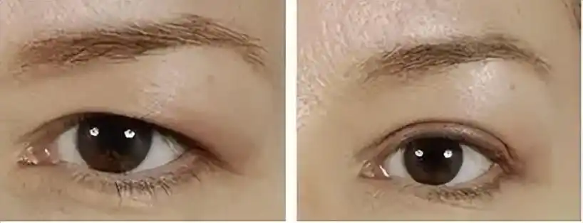 列举,提眉术和全切双眼皮哪个效果好?提眉手术可以保持几年!