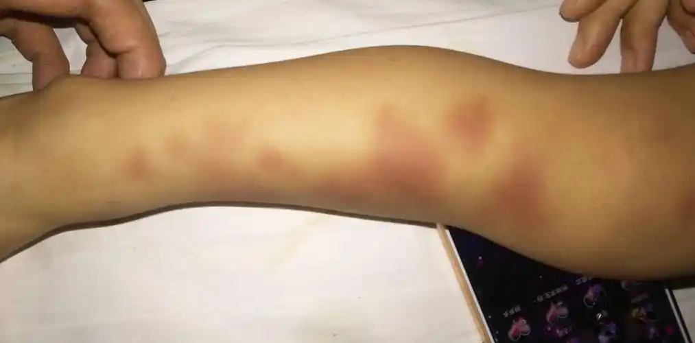 患儿全身出现瘀斑你需要注意这种疾病