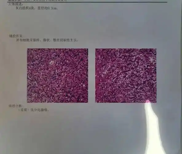 岳西博爱医院在无痛胃镜检查中发现一例早期胃癌