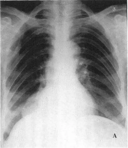 (图) 大细胞中分化型肺癌