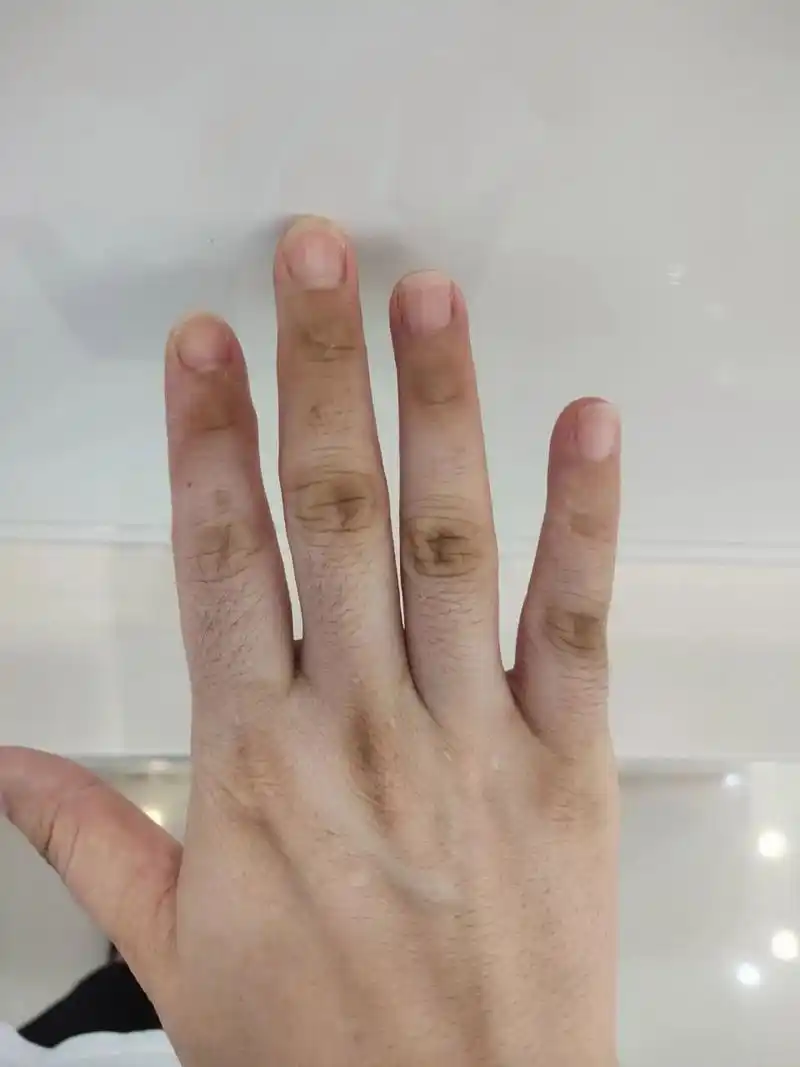 指关节发黑 之前我的手指关节比这个还黑,现在慢慢已经偏黄了,这种