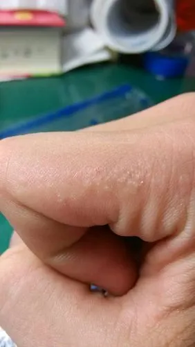 手上有小疙瘩,挤破后有清澈液体流出,上面