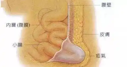 疝气不善,家有老人的要注意了_腹股沟_患者_老年