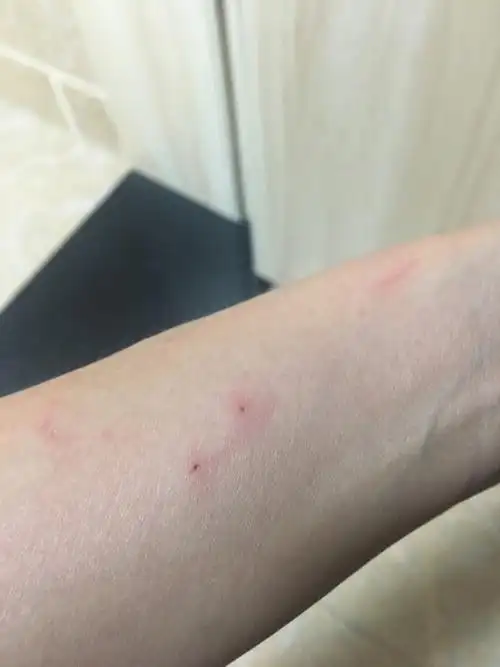 被野猫咬出血了,咬出了印子.当时出血了回来就用洗手液清洗了,算严