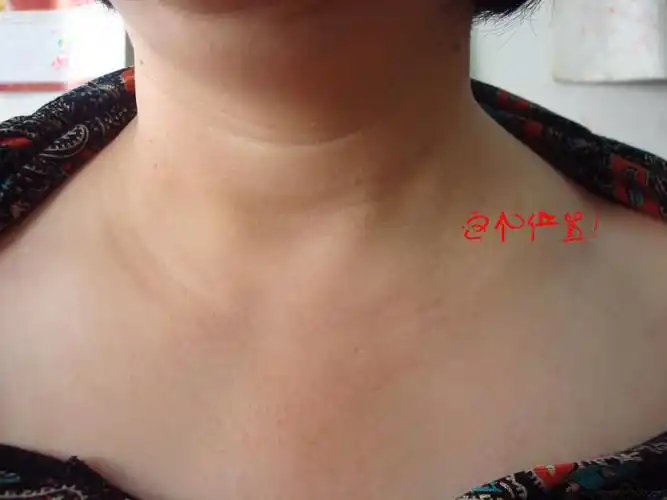 在左锁骨上窝斜方肌处突然凸出如图!