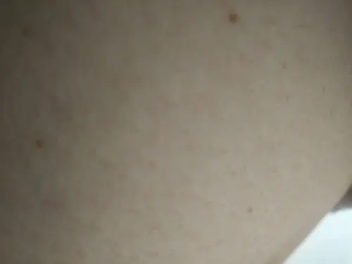 皮肤褐色点 女,21岁,双乳上有褐色点,左乳多一点,出现最少有一年多了