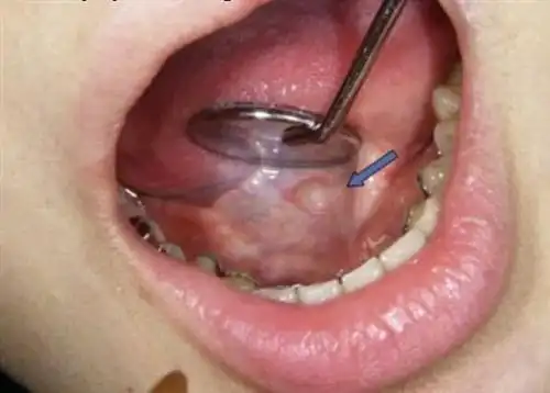 扁桃体癌的症状?